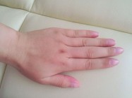 手肿是什么原因？手肿怎么缓解？