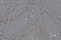 念珠菌阳性代表什么？念珠菌性阴道炎常见症状
