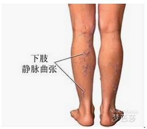 医用静脉曲张袜品牌