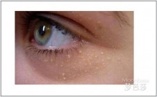去除眼部脂肪粒的眼霜 这么用可以让脂肪粒消失